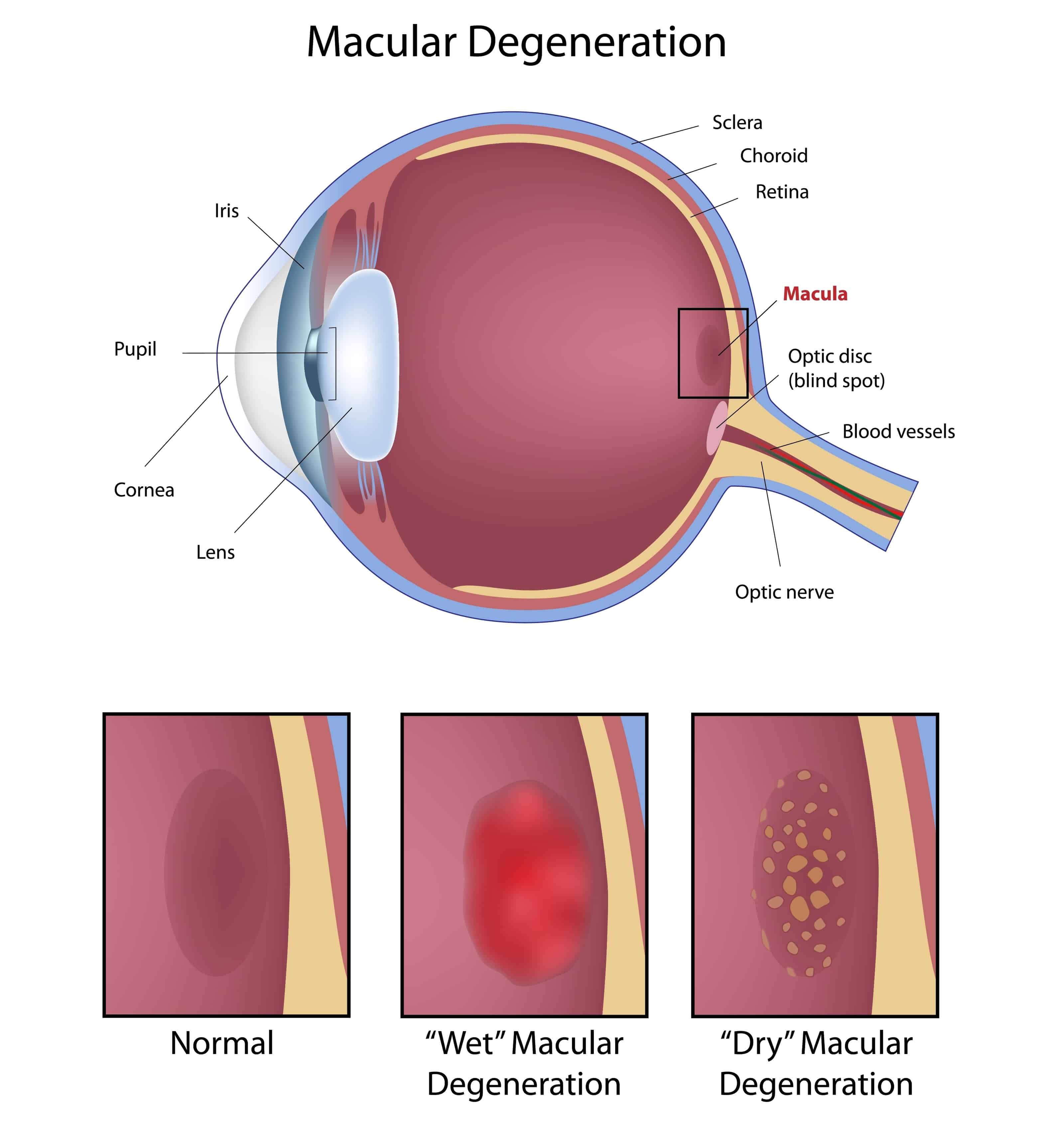 Macular Degeneration
